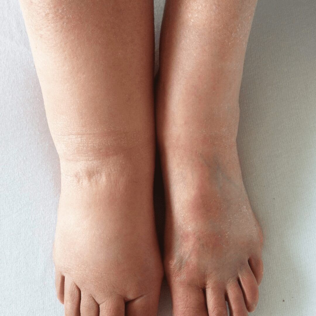 Dor e Inchaço Nas Pernas: Quando é Hora de se Preocupar?