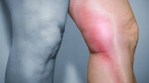 Trombose, Trombose Arterial e Trombose Venosa: O que são?